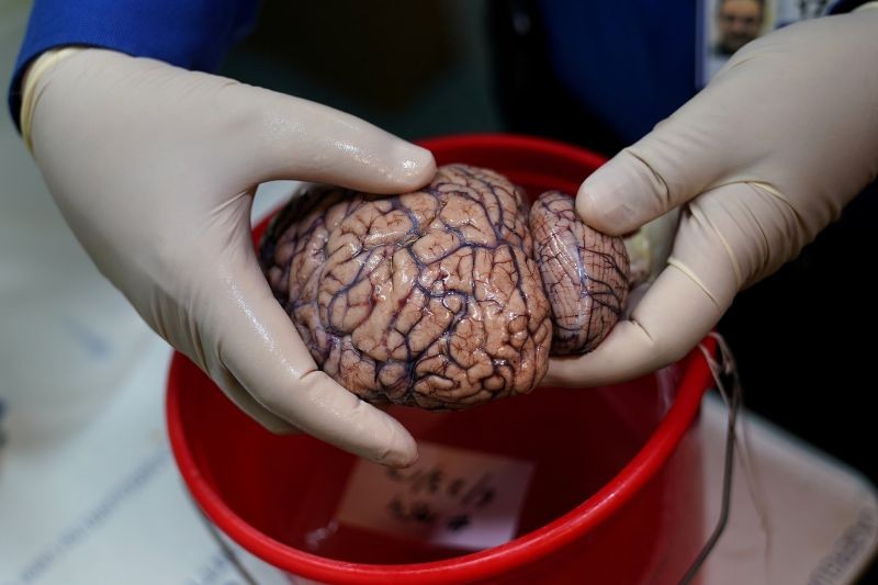 Dr. Vahram Haroutunian holds a human brain in a brain bank in the Bronx borough of New York City, New York, U.S. June 28, 2017.  (REUTERS File Photo)