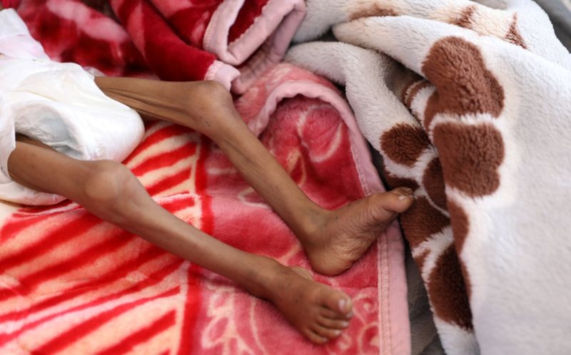 A malnourished girl lies on a bed at the malnutrition treatment ward of al-Sabeen hospital in Sanaa, Yemen October 27, 2020. (REUTERS File Photo)