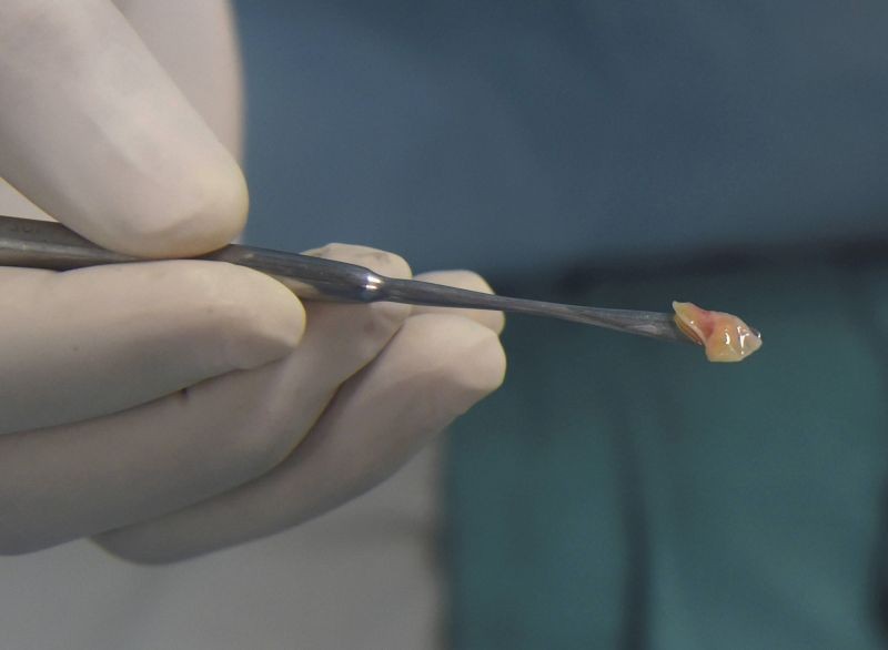 Ghaziabad: ENT (Ear-Nose-Throat) specialist Dr. BP Tyagi shows yellow fungus infected tissue, after performing an extended Functional Endoscopic Sinus surgery on Rajesh Kumar, a mucormycosis patient from Muradnagar, at a hospital in Ghaziabad, Friday, May 28, 2021. (PTI Photo/Manvender Vashist)