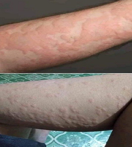 Screenshot from a post regarding Lumpy Skin disease on a Nagaland-based Facebook group shared simply with the caption, "Beware..." (Top) The photo of person's hand with apparent skin infection, shared on viral social media implying LSD, pertains to skin rash and was first uploaded on iStock Photo by Getty Images on August 9, 2012, with the caption, "A man's arm covered in a rash from an allergic reaction (steroids and antihistamines cleared it up)" under "Rash due to allergic reaction…’ category. (Bottom) As per Google Images, this photo was uploaded by a user in the comment section of a Thailand-based Facebook page, in a post sharing various skin diseases/rashes/allergies under the caption, "Only those who have this can understand...!!" on April 28, 2019.